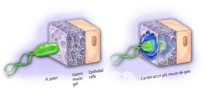 Дуоденит может развиваться из-за инфицирования желудка бактерией Helicobacter Pylori