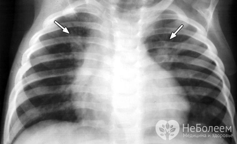 Симптомы двухсторонней пневмонии