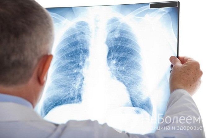 Основной метод диагностики двухсторонней пневмонии – рентгенография легких