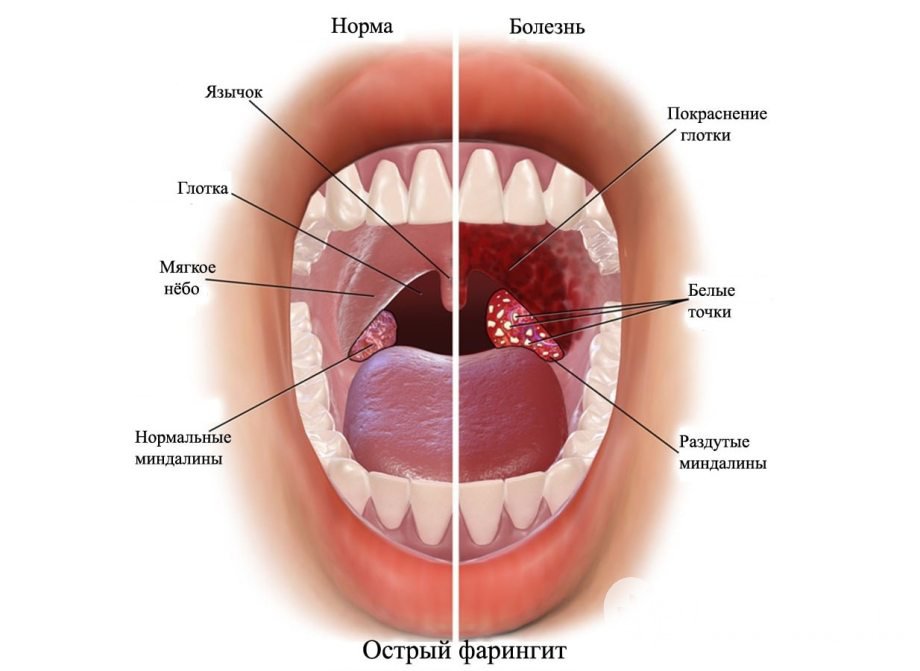 Признаки фарингита у детей