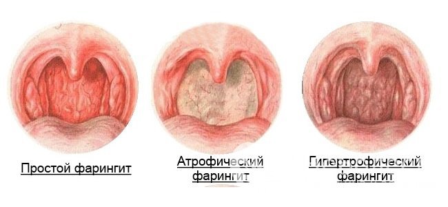 Виды хронического фарингита