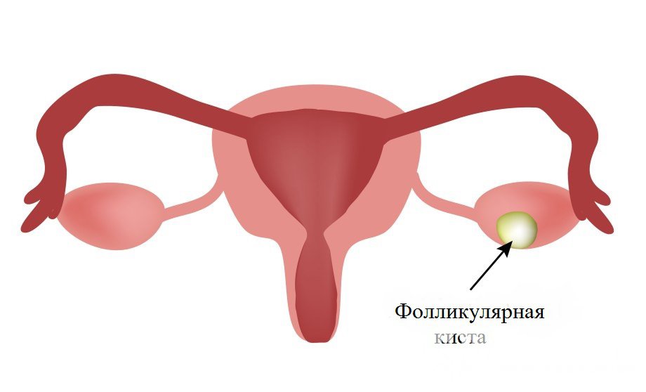 Признаки фолликулярной кисты яичника