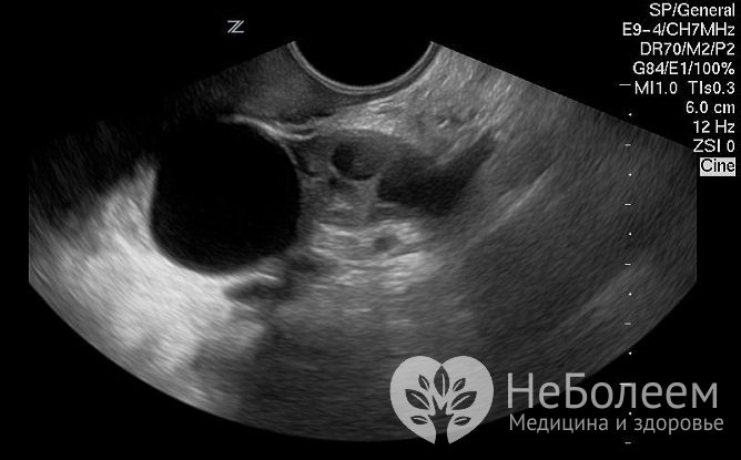 Фолликулярная киста яичника хорошо просматривается на УЗИ