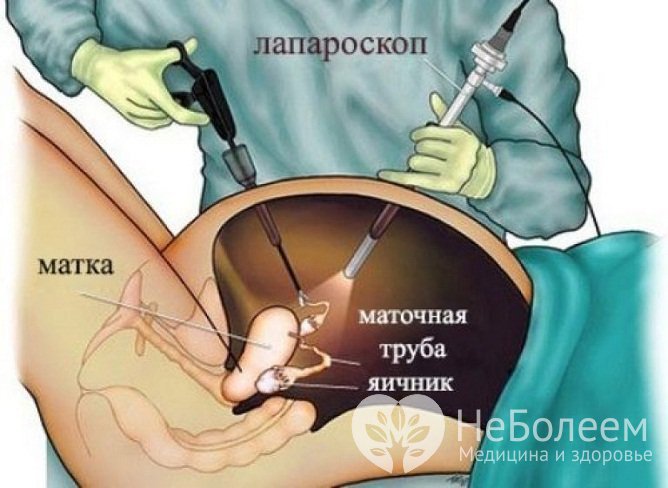 Хирургическое лечение фолликулярных кист обычно проводится лапароскопическим методом