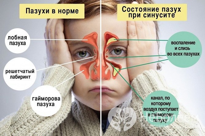 При гайморите у детей наблюдается воспаление в гайморовых пазухах носа