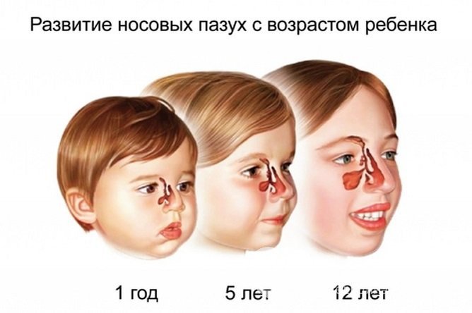 Чаще всего у детей диагностируется гайморит после 12 лет