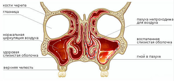 При гнойном гайморите в гайморовой пазухе скапливается гной