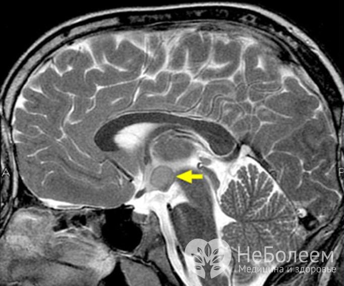 Признаки гамартомы гипоталамуса