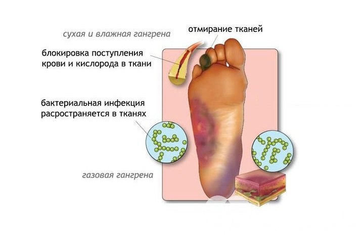 Признаки гангрены