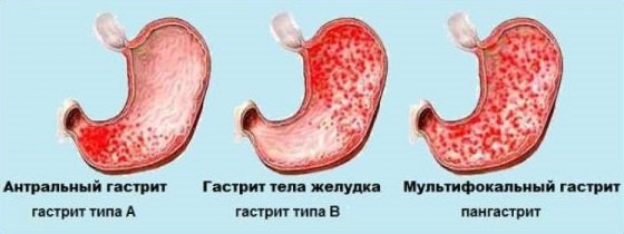 Формы гастрита в зависимости от очага поражения