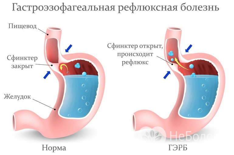 Признаки гастроэзофагеальной рефлюксной болезни