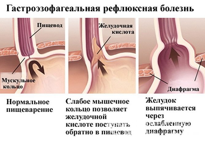 Что происходит при гастроэзофагеальной рефлюксной болезни