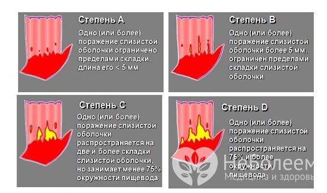 Степени гастроэзофагеальной рефлюксной болезни