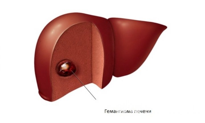 Признаки гемангиомы печени