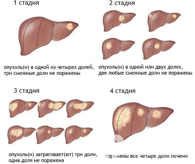 Стадии гемангиомы печени