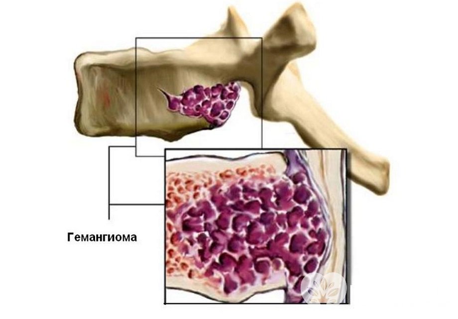 Признаки гемангиомы позвоночника
