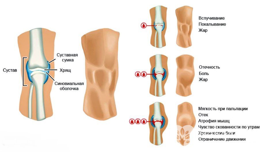 Признаки гемартроза коленного сустава