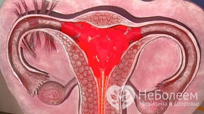 Гематометра – скопление крови в полости матки