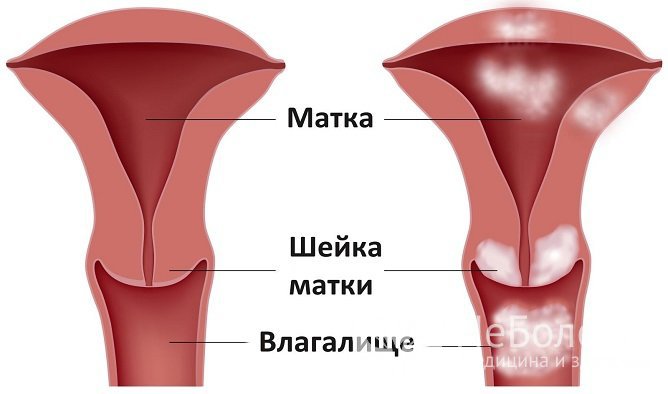 Причиной гематометры может являться рак эндометрия