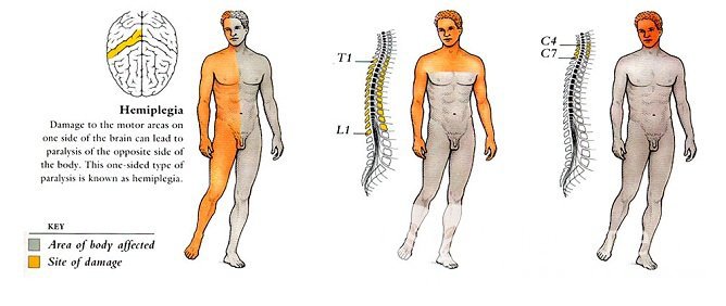 Варианты поражения при гемиплегии