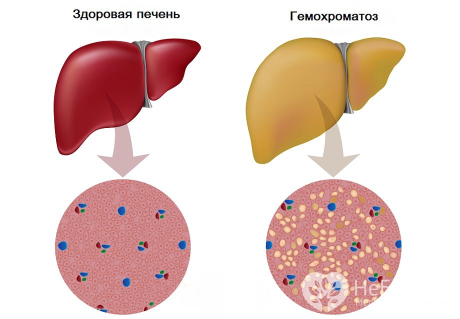 Гемохроматоз симптомы