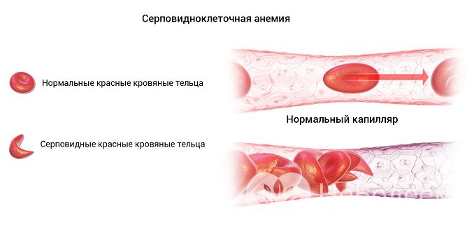 Серповидноклеточная анемия – врожденная гемоглобинопатия