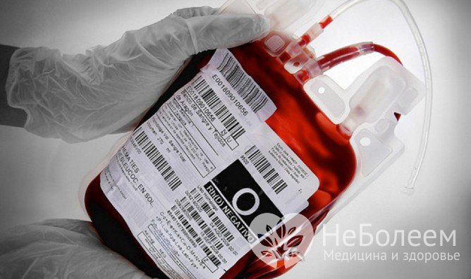 Трансфузия свежезамороженной плазмы крови – один из методов лечения гемолитической анемии