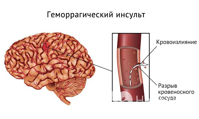 Признаки геморрагического инсульта