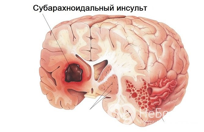 Субарахноидальный геморрагический инсульт