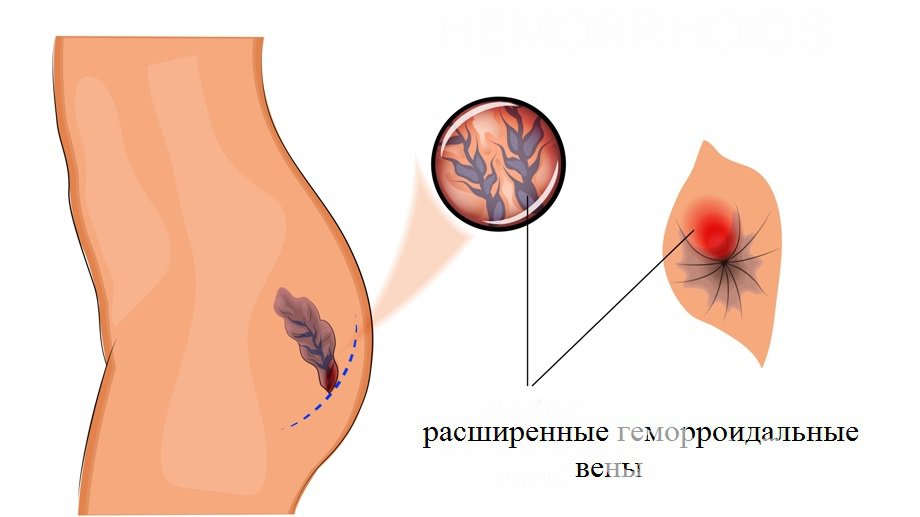 Признаки геморроя при беременности