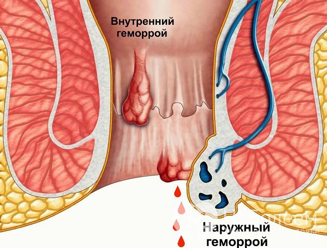 При внутреннем геморрое узлы располагаются внутри анального канала и их не видно снаружи