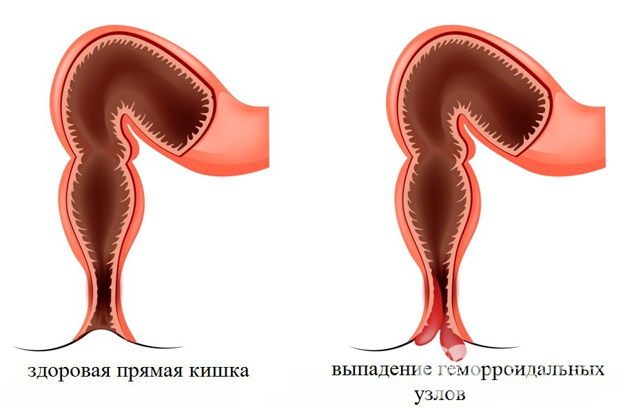 Признаки геморроя у мужчин