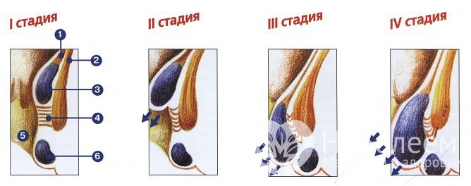 Выделяют 4 стадии геморроя