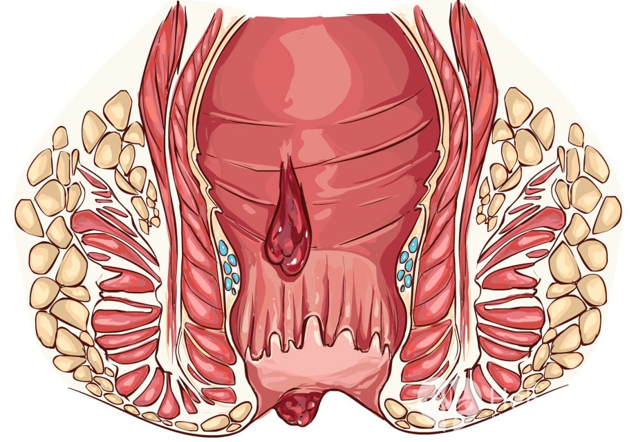 Признаки геморроя