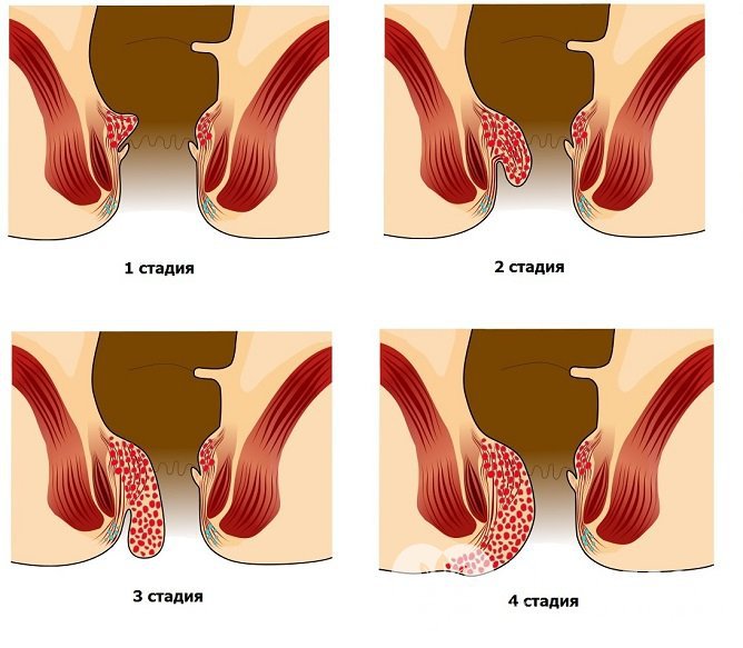 Стадии геморроя у женщин