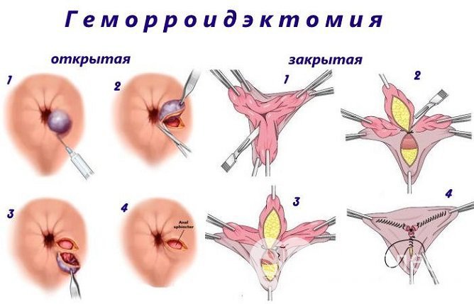 На поздних стадиях геморроя рекомендовано проведение хирургического лечения - геморроидэктомия