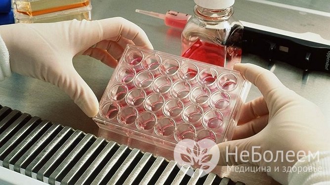 При подозрении на гепатит А проводят исследование крови
