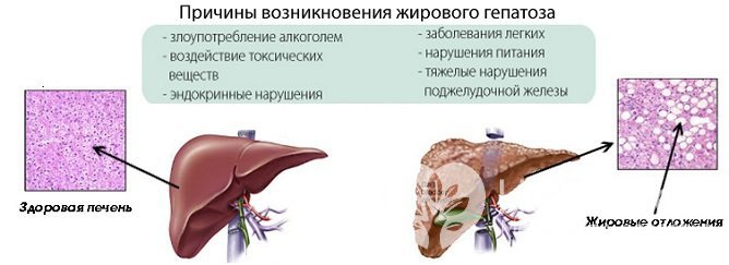 Форма гепатоза обусловлена причиной, вызвавшей заболевание