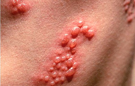 Симптомы герпетической инфекции кожи