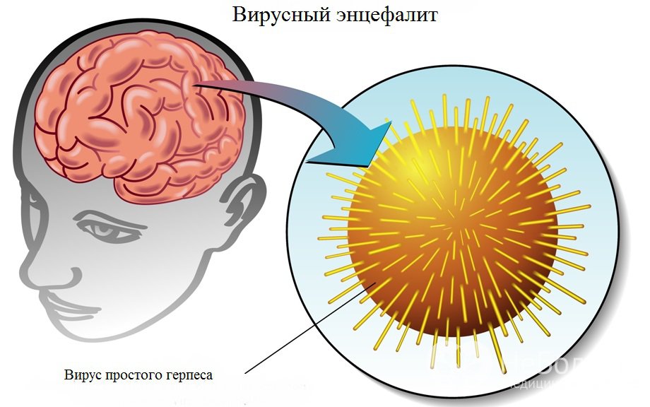 Признаки герпетического энцефалита 