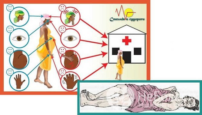 Приступ эклампсии при гестозе