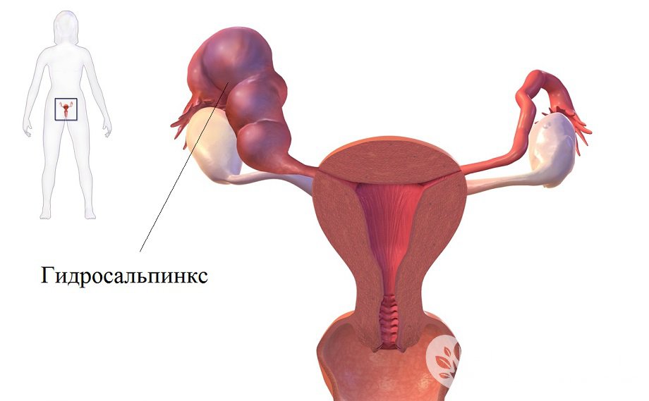 Признаки гидросальпинкса