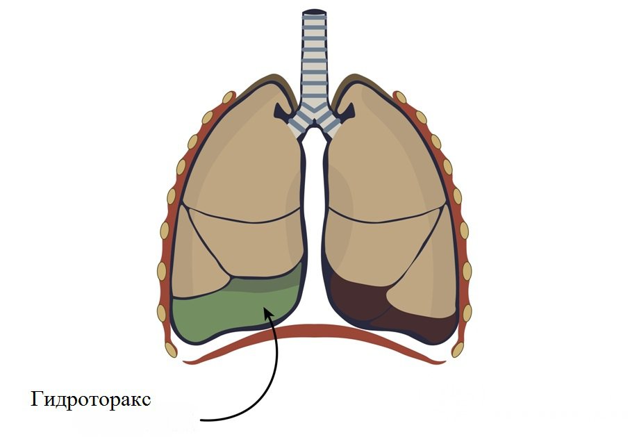 Признаки гидроторакса
