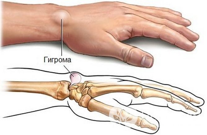 Гигрома запястья: симптомы и лечение