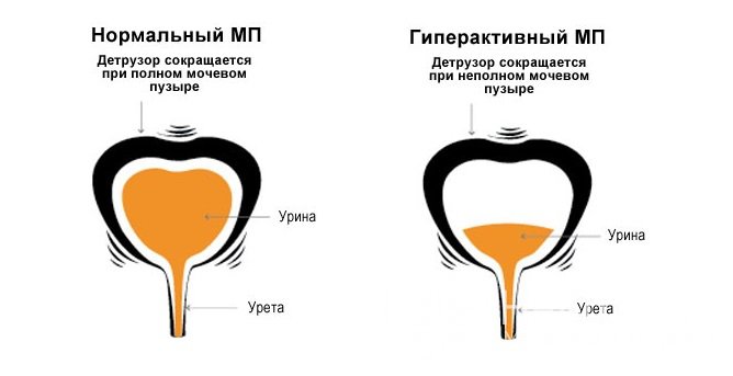 Гиперактивный мочевой пузырь: симптомы и лечение