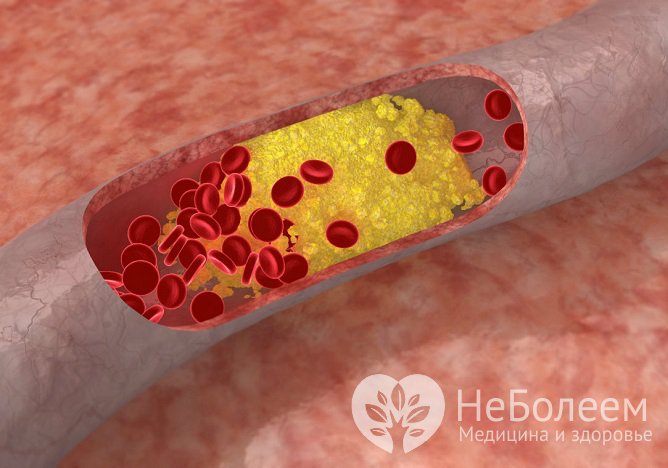 Гиперхолестеринемия: симптомы и лечение