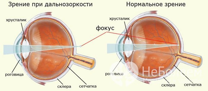 Гиперметропия (дальнозоркость) 