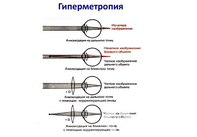 Симптомы гиперметропии