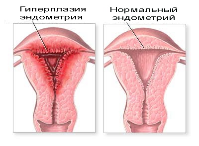 Гиперплазия эндометрия: симптомы и лечение