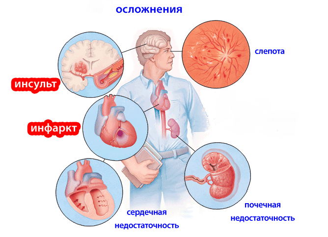 Возможные осложнения гипертонической болезни